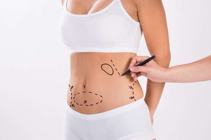 liposuction