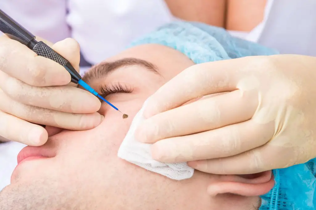mole removal singapore