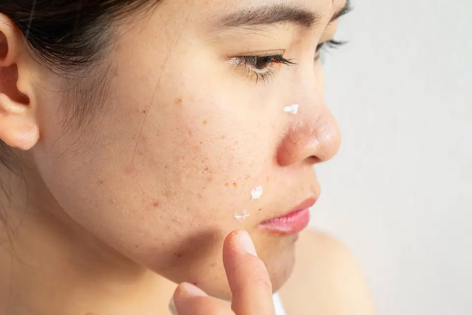 best pimple creams in singapore