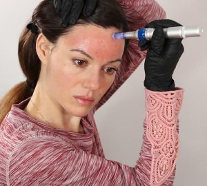 best microneedling pen