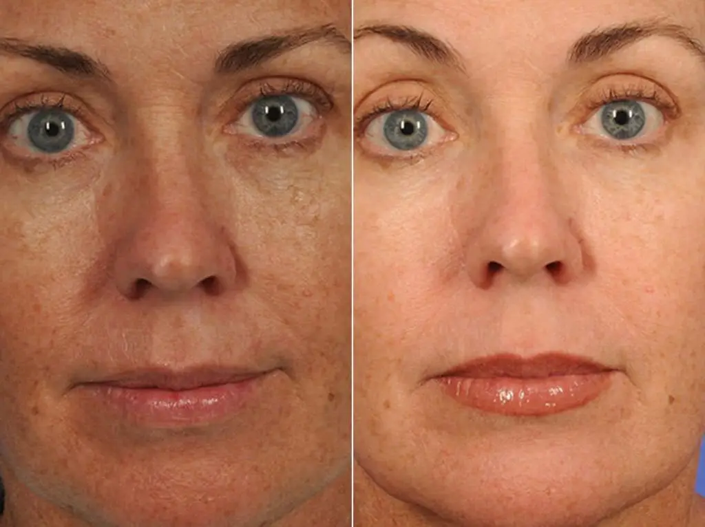 Microdermabrasion Before And After How It Works Pros And Cons Etc 3454