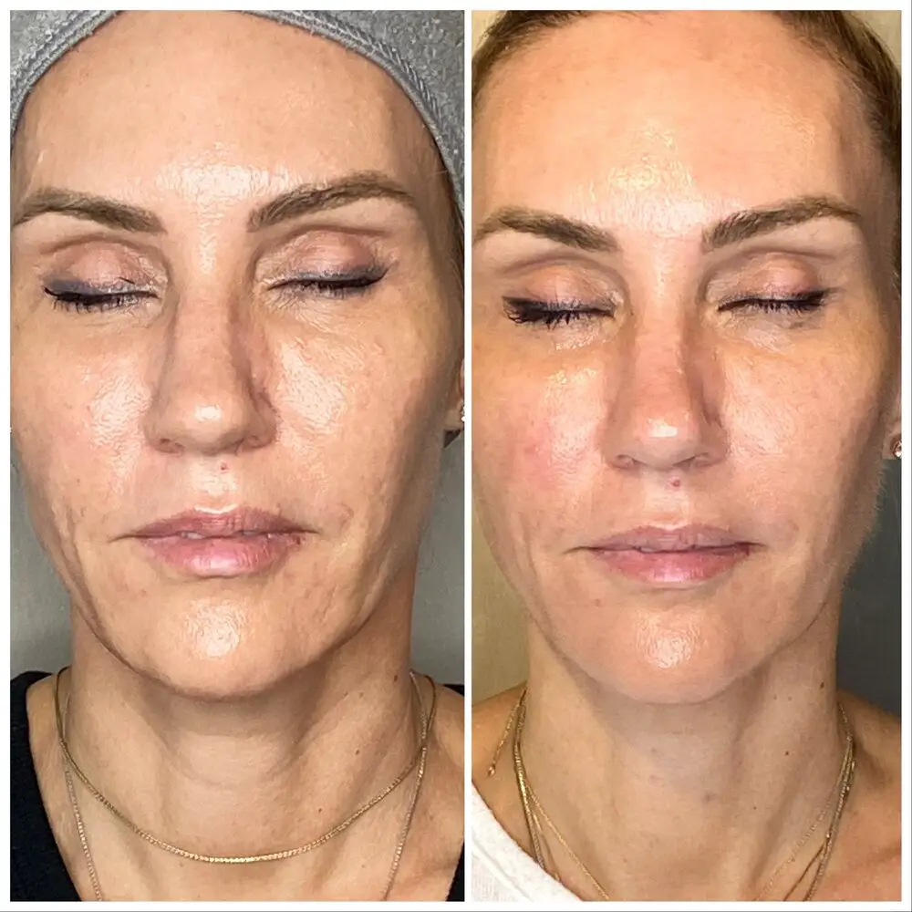 Microdermabrasion Before And After How It Works, Pros & Cons, etc.