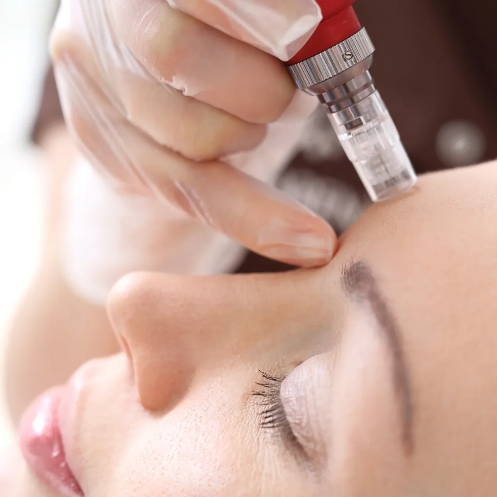 what is microneedling