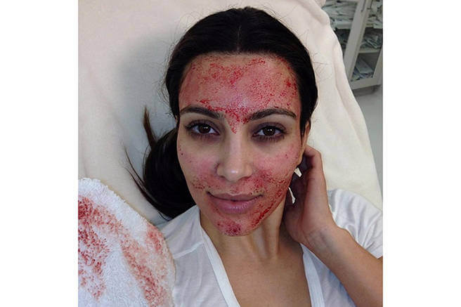 Side Effects Of Microneedling