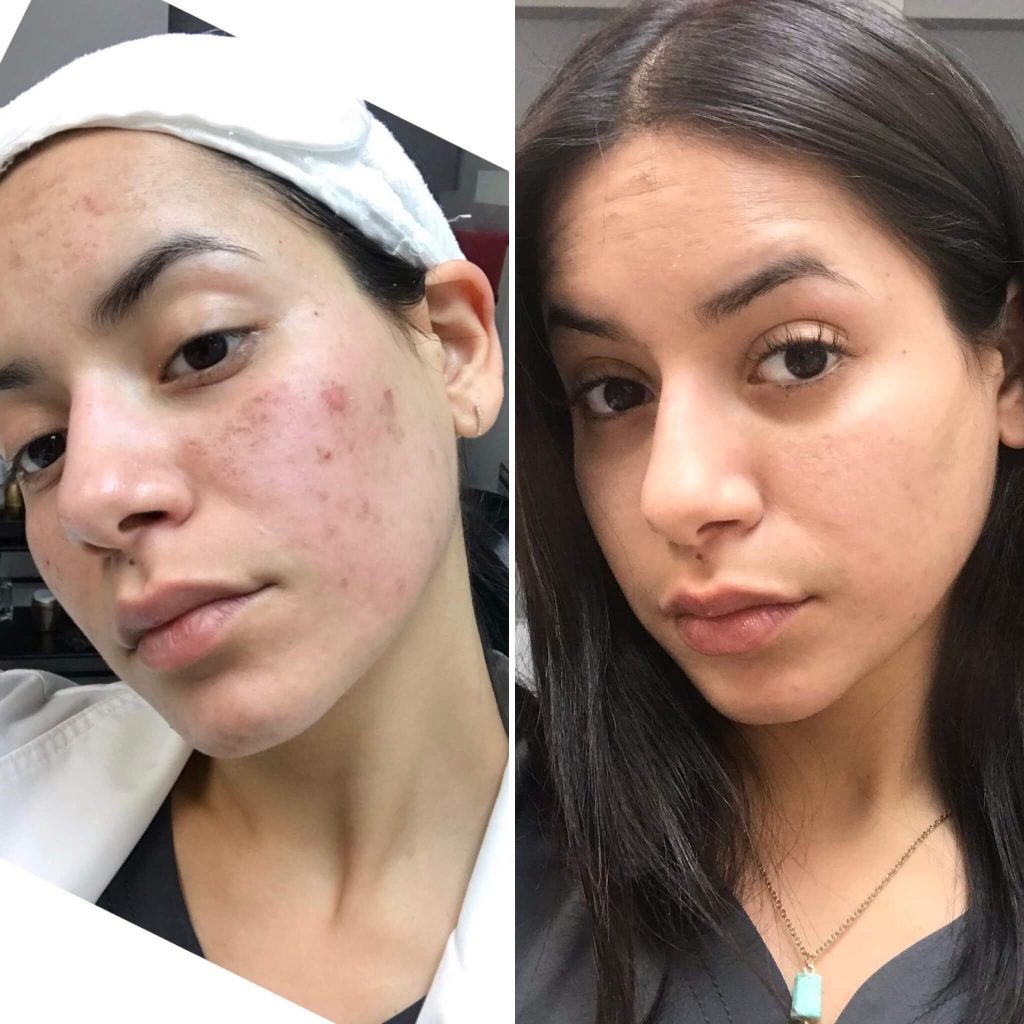 what is microneedling good for