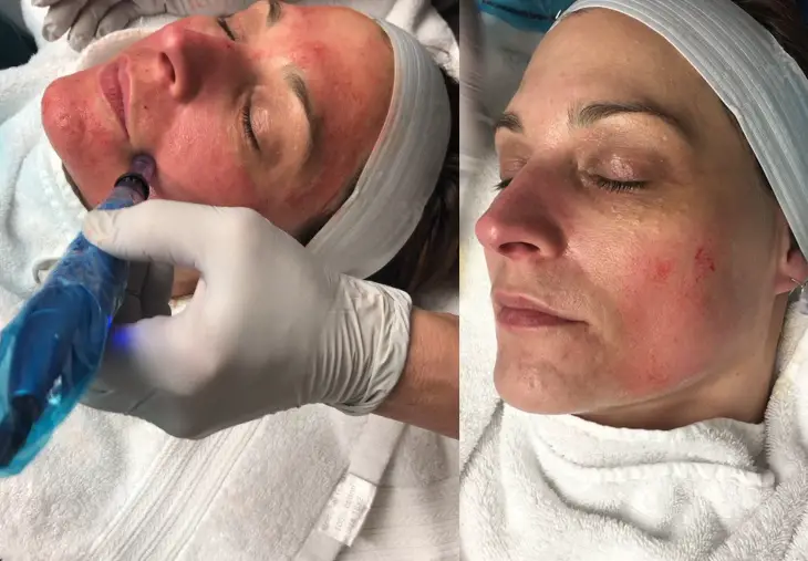 what is microneedling
