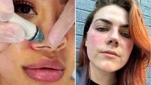 Hydrafacial side effects